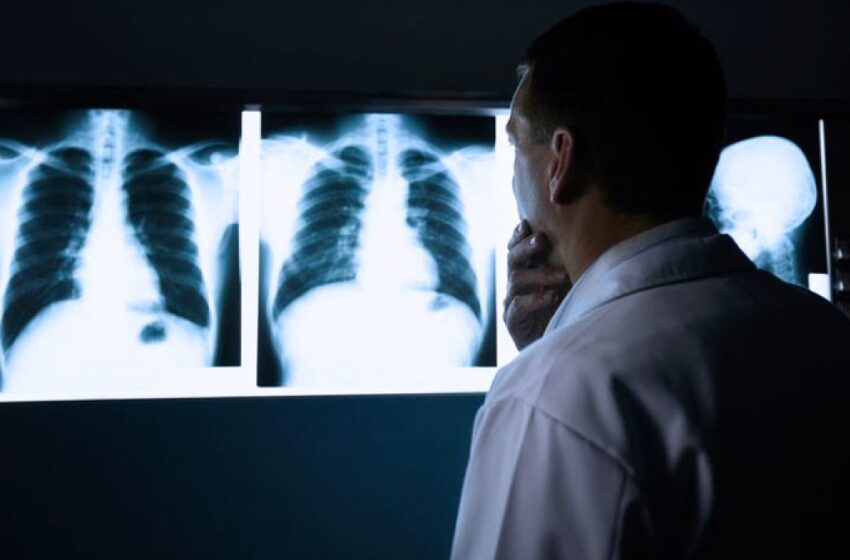  Angola reduz mortalidade por tuberculose para metade 